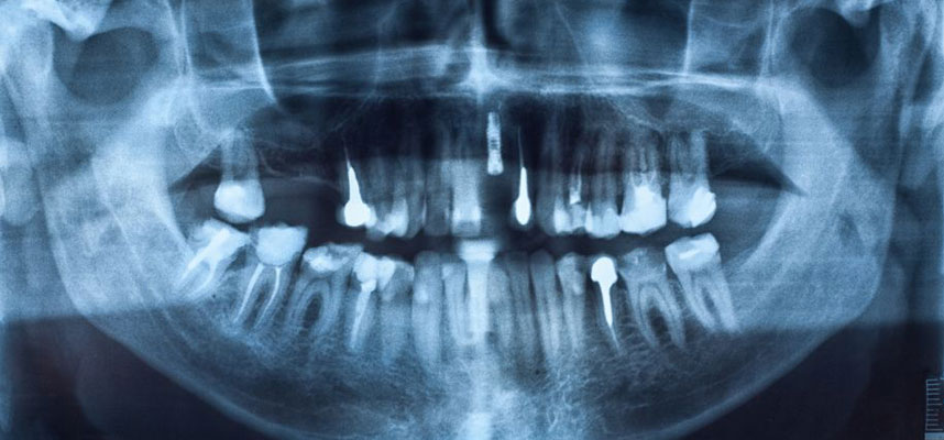 CBCT: Cone Beam Computed Tomography